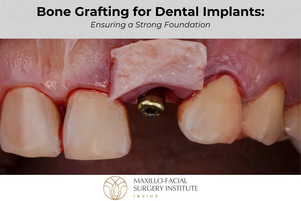 Bone Grafting for Dental Implants: Ensuring a Strong Foundation