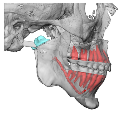 TMJ Replacement