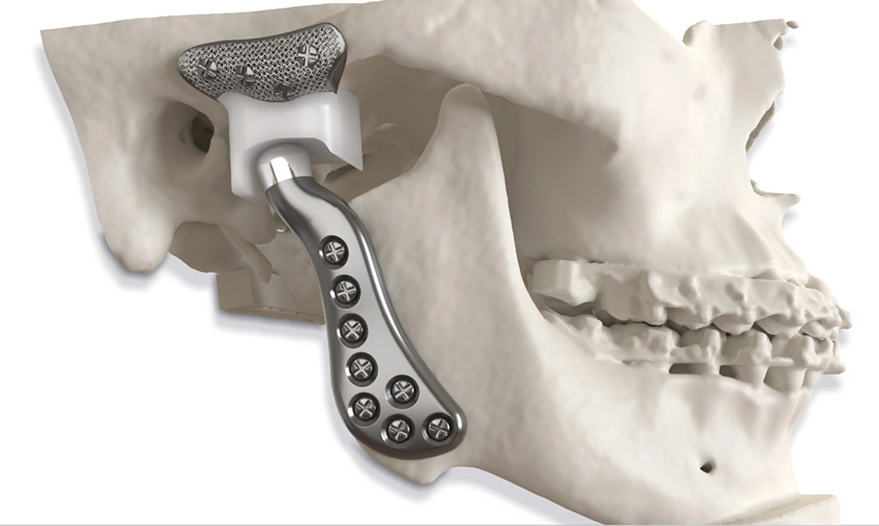 TMJ Replacement