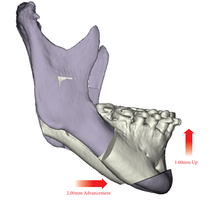 Orthognathic Jaw Surgery