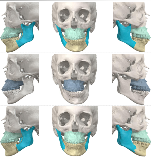 Orthognathic Jaw Surgery